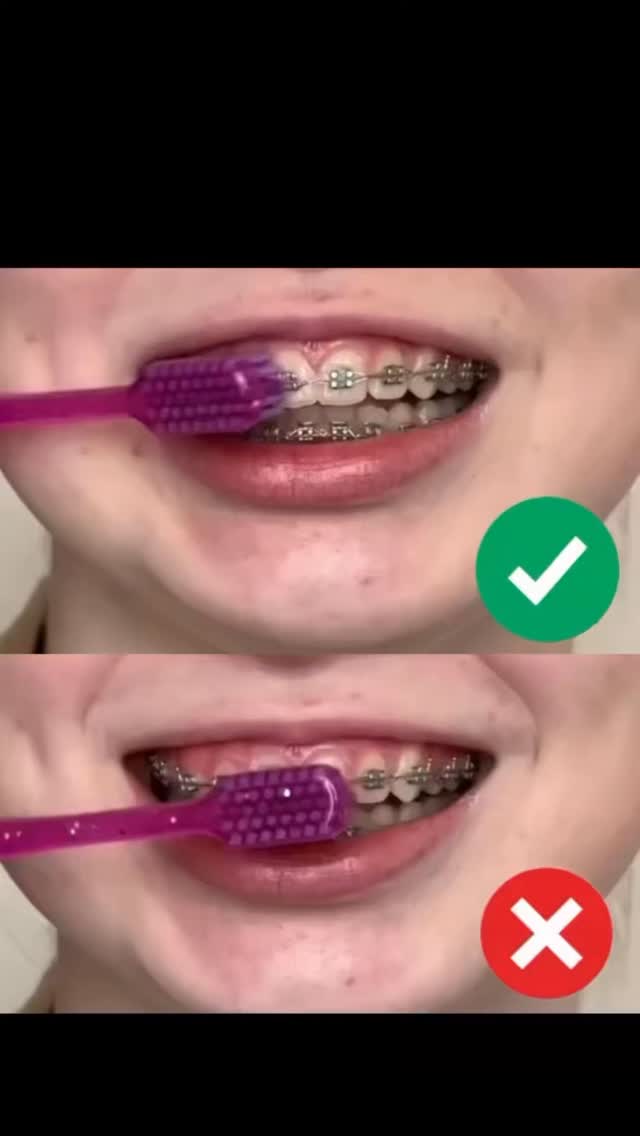 Brushing with braces just got easier!

Proper brushing is the secret to a healthy, beautiful smile during your orthodontic treatment. 

Watch and follow along — your teeth will thank you later! 😁🦷

Small habits every day lead to big smile transformations! 💫

👩‍⚕️ Dr. Manimegalai | Tara's Dental & Aesthetic Center, Velachery, Chennai
📞 Book your orthodontic consultation today — Link in bio #chennaidentist #orthodontistlife #BracesLife #OrthodonticHygiene #BracesCleaningTips OralHealthTips BracesCare OrthoTips DentalCare BracesAdvice BrushingWithBraces OrthoPatientEducation ChennaiOrthodontics VelacheryDentist TarasDental ChennaiSmile DentalHygiene