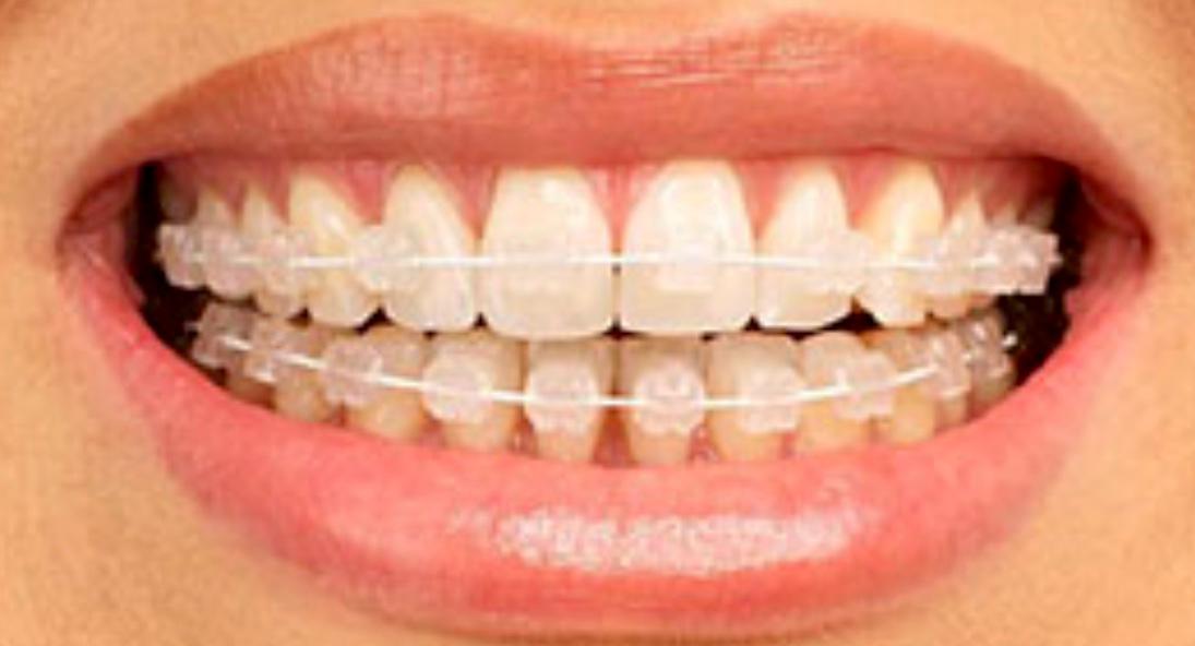 Close-up of a bright smile after cosmetic dental treatment